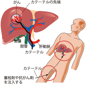 肝動脈塞栓術イメージ