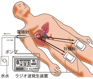 ラジオ波焼灼術とは | 肝臓がんの治療について | 東京大学医学部附属 